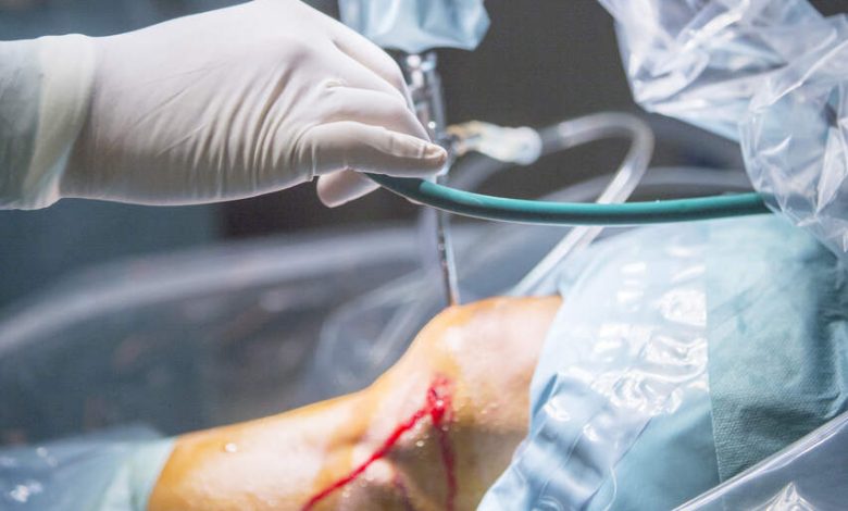 Sutura do menisco quando ela é indicada