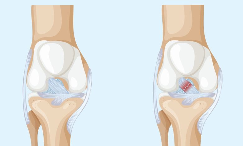 Lesão do LCA o problema que pode estar no seu joelho sem você saber